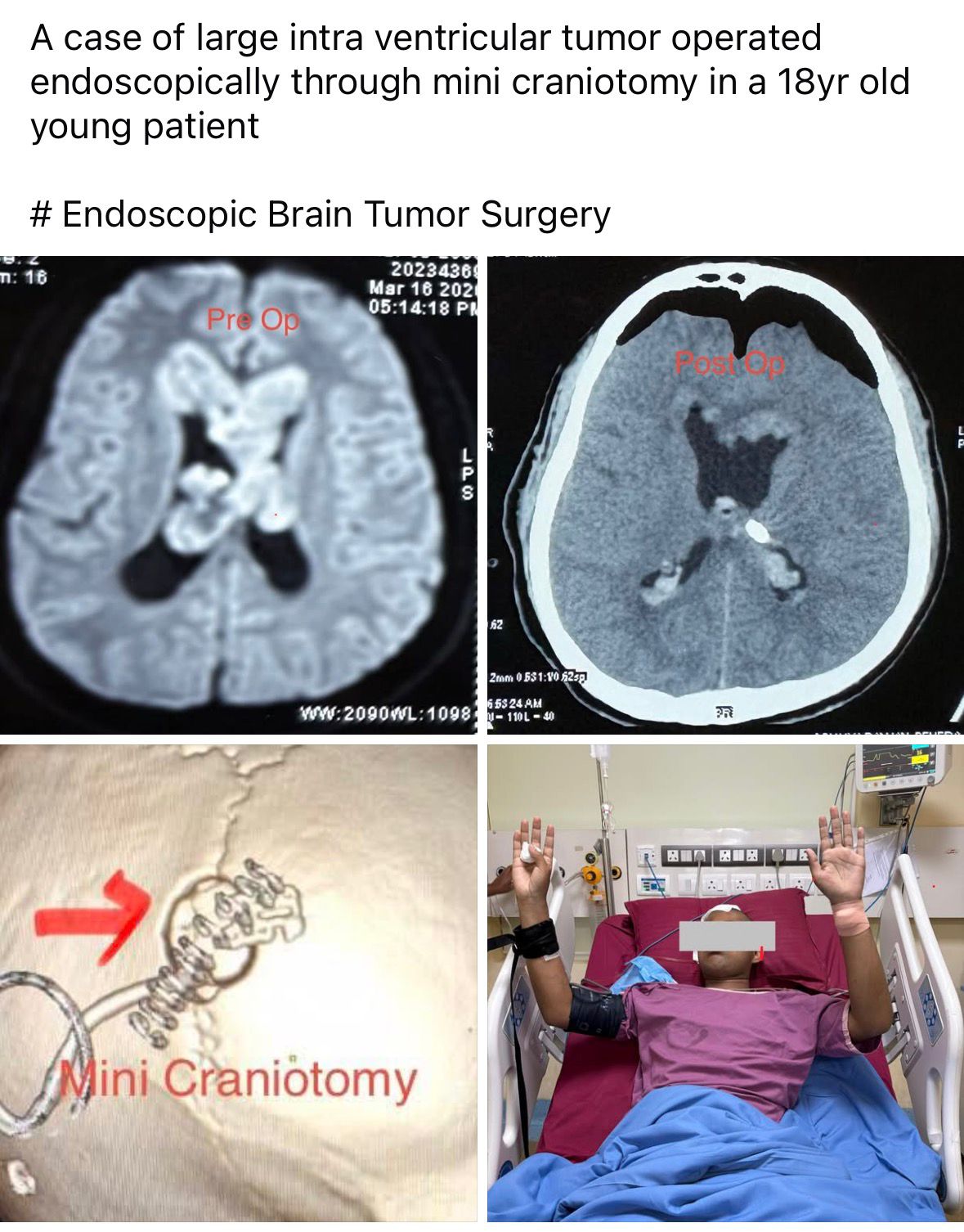 Endoscopic Brain Tumor Surgery in Bhubaneswar – Mini Craniotomy for Intraventricular Tumor